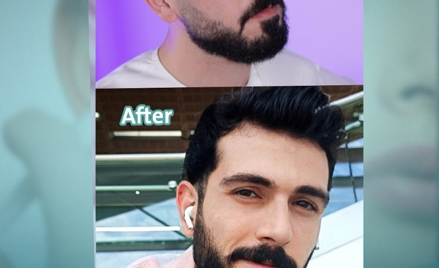 الميزوثيرابي للشعر في أبوظبي: استعادة الكثافة والقوة